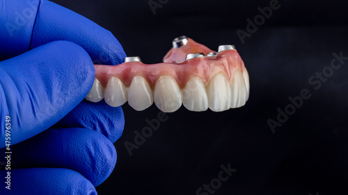 Dental implants and dentures in close-up Siemke on a black background	
