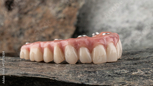 Dental implants and dentures in close-up Siemke on a black background	
