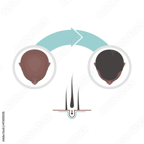 Hair transplantation surgery infographics. Patient before and after the procedure. Male hair loss treatment with FUT, FUE method. Alopecia medical design for clinics and diagnostic centers.