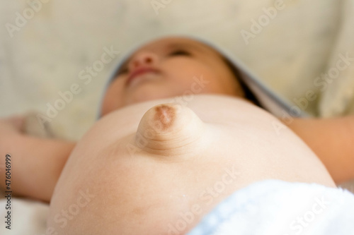 Three month old baby with a very apparent umbilical hernia bouncing out of her belly. Need for medical intervention for resolution. Parental care and precautions with the bowel, digestive system.