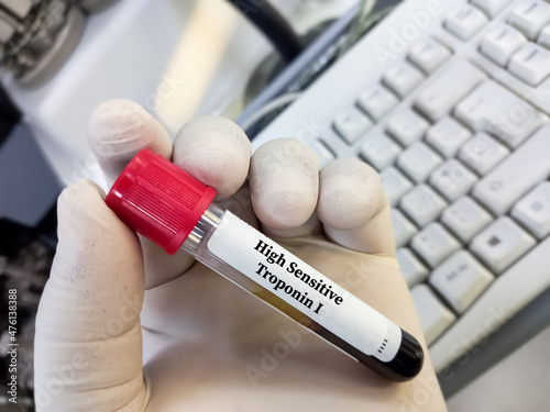 Test tube with blood sample for High sensitive troponin I (hs-troponin I) test, diagnosis of myocardial infraction.