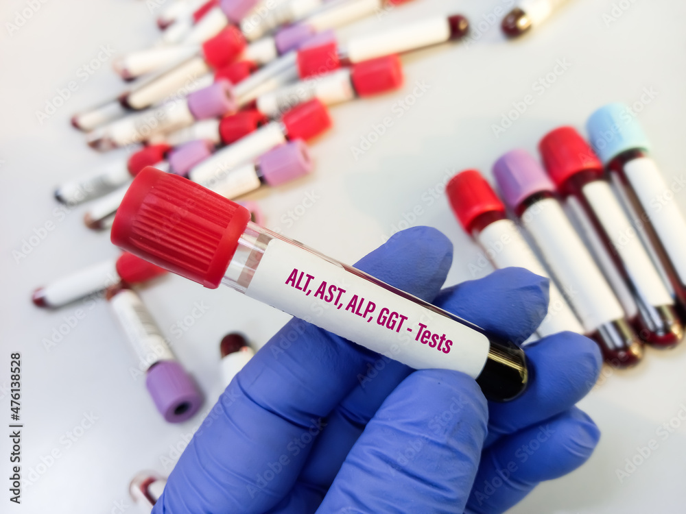 Laboratory sample tube with blood for Liver function test(ALT,AST,ALP