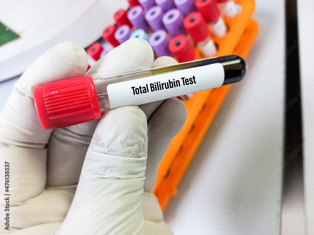 Scientist hold blood sample for Total bilirubin test, diagnosis of