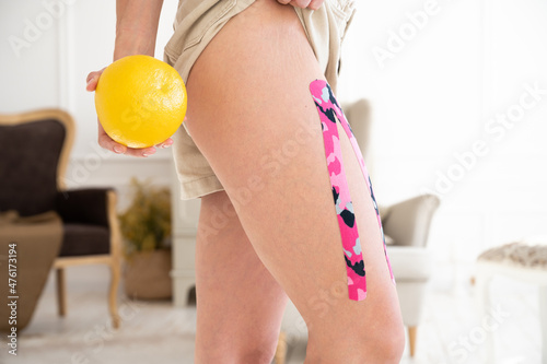 Aesthetic taping for cellulite removal. Woman holding grapefruit and showiing problem zone. Cellulite treatment photo
