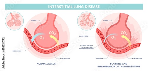 Capillary dry cough of wood metal dust breath virus Chest X-ray Cancer scan High resolution HRCT Biopsy usual COPD chronic asbestos corona covid 19 cystic diagnose disorder dyspnea fibers ILD UIP IPF