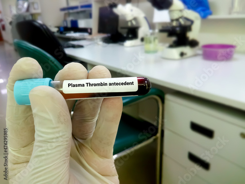 Obraz na plátně Blood sample for plasma thromboplastin antecedent or factor XI test, diagnosis o