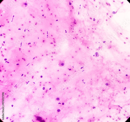 Lung mass CT Guided FNA   Inflammatory lesion  microscopy show polymorphs  lymphocytes  histiocytes  reactive bronchial cells. No malignant cell.