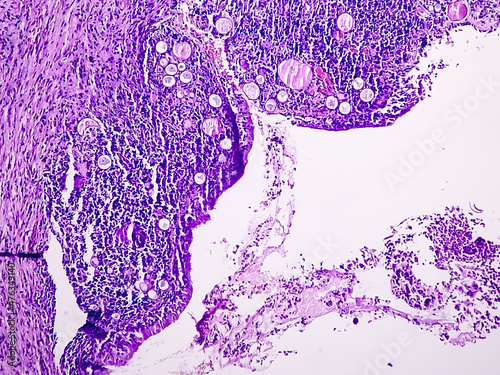 Leiomyoma, or fibroids, is a smooth muscle benign tumors, light micrograph, photo under microscope photo