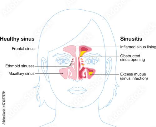 Sinusitis, vector illustration, labeled photo