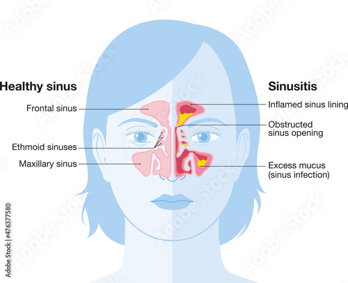 Sinusitis, vector illustration_1 photo