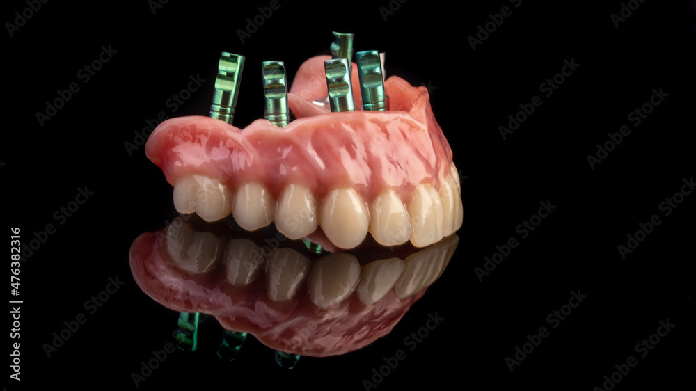 Dental implants and dentures in close-up Siemke on a black background
Dental implants and dentures in close-up Siemke on a black background
