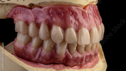 Dental implants and dentures in close-up Siemke on a black background 