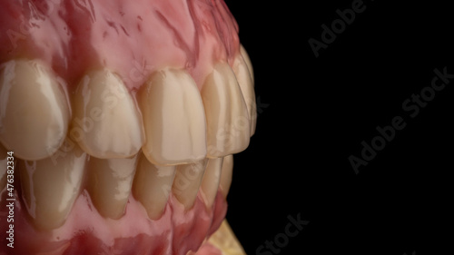 Dental implants and dentures in close-up Siemke on a black background	
