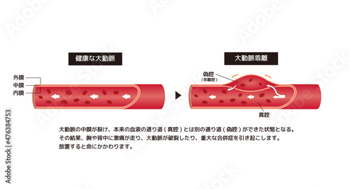 健康な大動脈と大動脈乖離の比較イラスト (解説文つき)