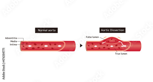 Comparison illustration of normal aorta and aortic dissection photo