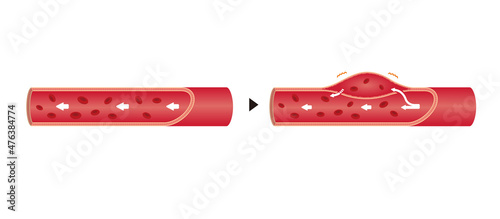 Comparison illustration of normal aorta and aortic dissection (no text)