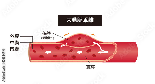 大動脈乖離の症状 / 血管断面図イラスト