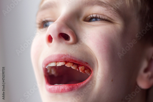 Unfocused face of boy with open mouth and blood on teeth, pediatric dentistry disease and dental and oral cavity treatment