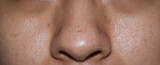 Blackheads or black heads on nose of Asian man.