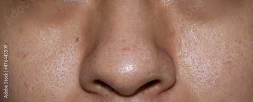 Blackheads or black heads on nose of Asian man.
