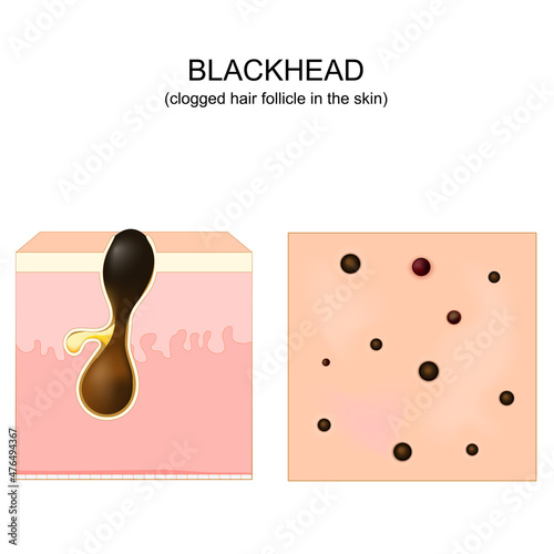 Acne. blackhead. clogged pore. Cross-section of a human skin