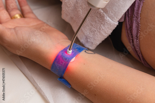 Treatment using an ilib wrist brace. photo