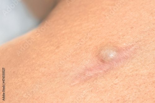 Recurrence Sebaceous Cyst (Epidermoid Cysts) at the incision of surgery on woman's shoulder blade. The recurrence rate depends heavily on the type of cyst, how large the cyst is. photo