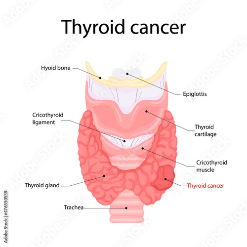 Thyroid cancer anatomy. Human body organs anatomy icon. Medical concept.