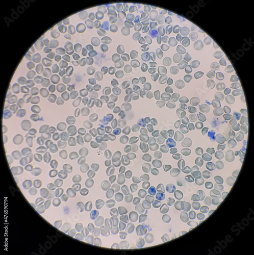 Reticulocyte count under microscope, 100x. methylene blue staining,reticulocyte count from blood smear photo