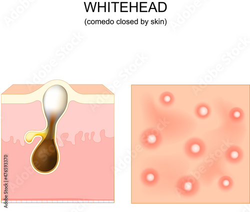 Acne. whitehead
