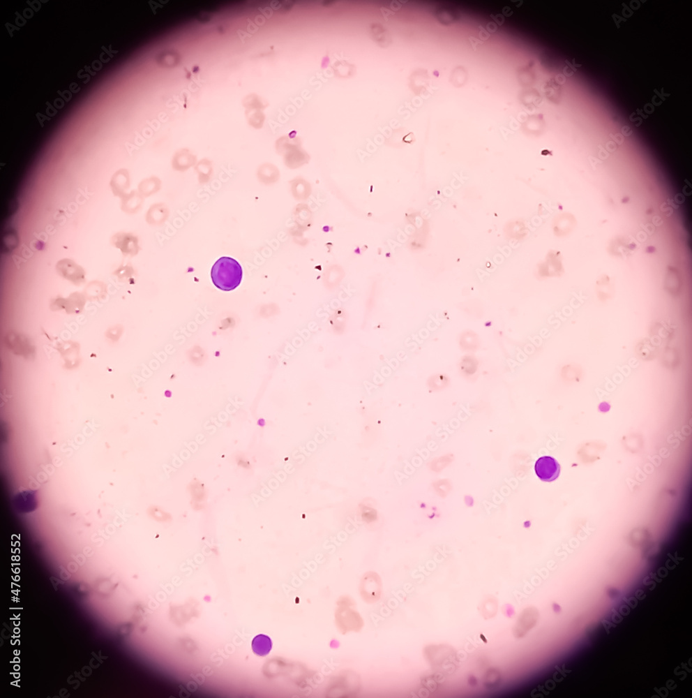 Foto de Leishman's stain microscopic show Leucoerythroblastic anemia