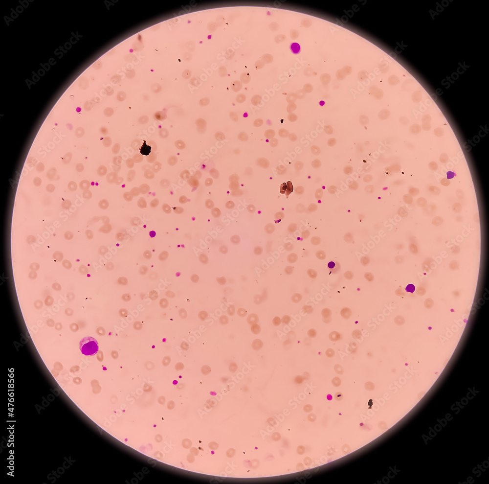 Leishman's stain microscopic show Leucoerythroblastic anemia with