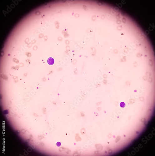 Leishman's stain microscopic show Leuco-erythroblastic anemia with thrombocytopenia, severe anemia, nRBC present. photo