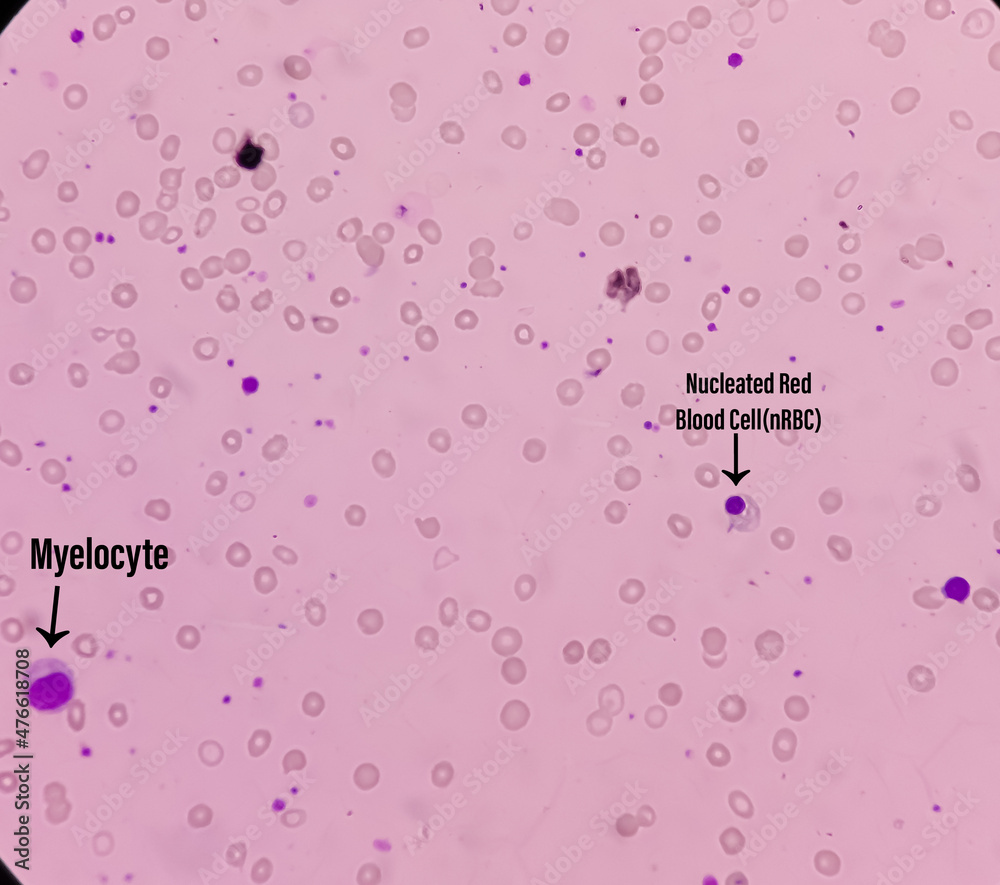 Leishman's stain microscopic show Leucoerythroblastic anemia with