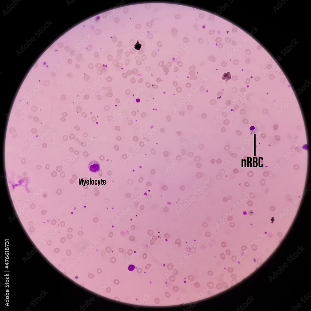 Foto de Leishman's stain microscopic show Leucoerythroblastic anemia