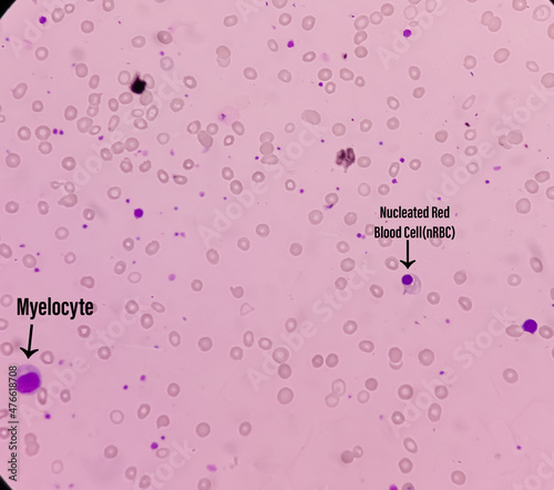 Leishman's stain microscopic show Leuco-erythroblastic anemia with thrombocytopenia, severe anemia, nRBC present. photo