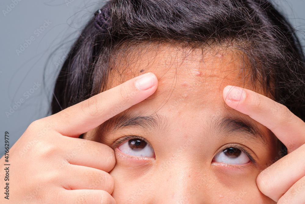 Closeup acne pimple on the forehead of child, eleven years old girl has