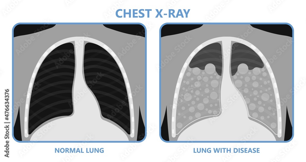 Acute respiratory distress syndrome (ARDS) a respiratory failure and inflammation in the lungs