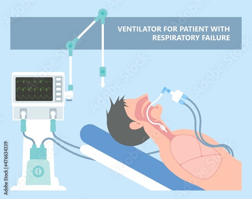 Acute respiratory distress syndrome (ARDS) a respiratory failure and inflammation in the lungs equipment hospital Emphysema fibrosis idiopathic Cystic Collapsed pneumothorax embolism X-Ray chest ICU