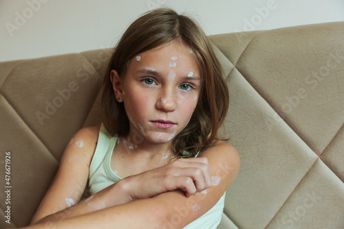 Obraz na plátně Cute little girl with chickenpox at home. Varicella zoster virus.