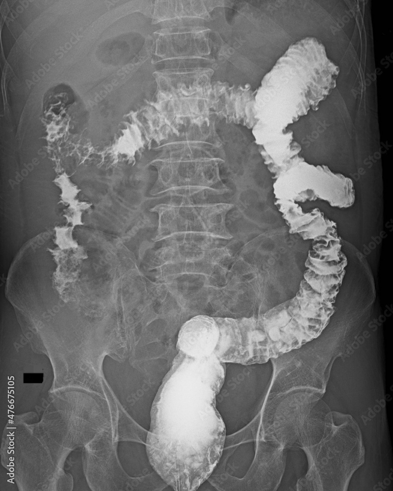 Xray imaging of colitis barium enema contrast study Stock Photo Adobe