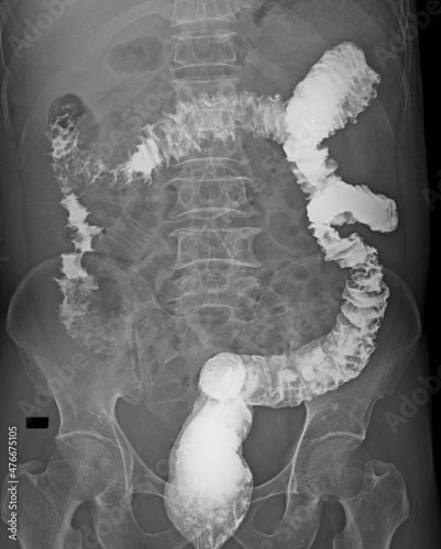 Xray imaging of colitis barium enema contrast study