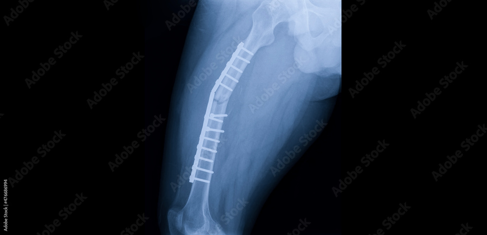A hip and thigh x-ray showing closed fracture at shaft of right femur. The patient has fixation with plate and screws. The image shows implant failure or broken plate at the fracture site. - obrazy, fototapety, plakaty 