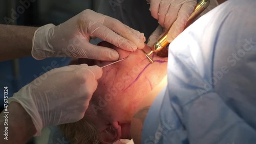 Beginning of plastic surgery for platysmoplasty to lift the neck and chin. Doctor and his assistant marked the patient's skin. Doctor inserts a long surgical needle into the patient's skin to perform 