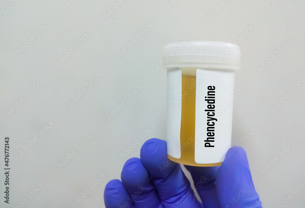 Medical laboratory urine container with urine sample for drugs test
