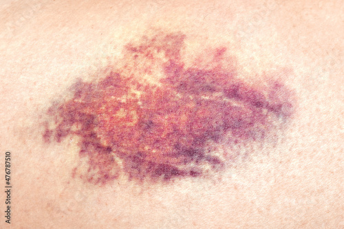 Close-up of a bruise on the wounded skin of a woman's leg. 