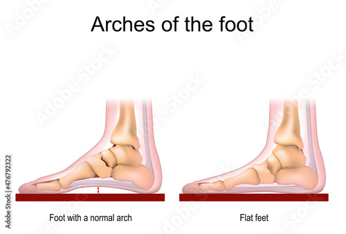 Foot with a normal arch and Flat feet.