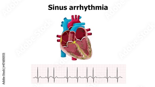 heart animation sinus arrhythmia with ecg