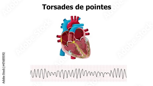 heart animation torsades de pointes (TDP) with ecg
 photo