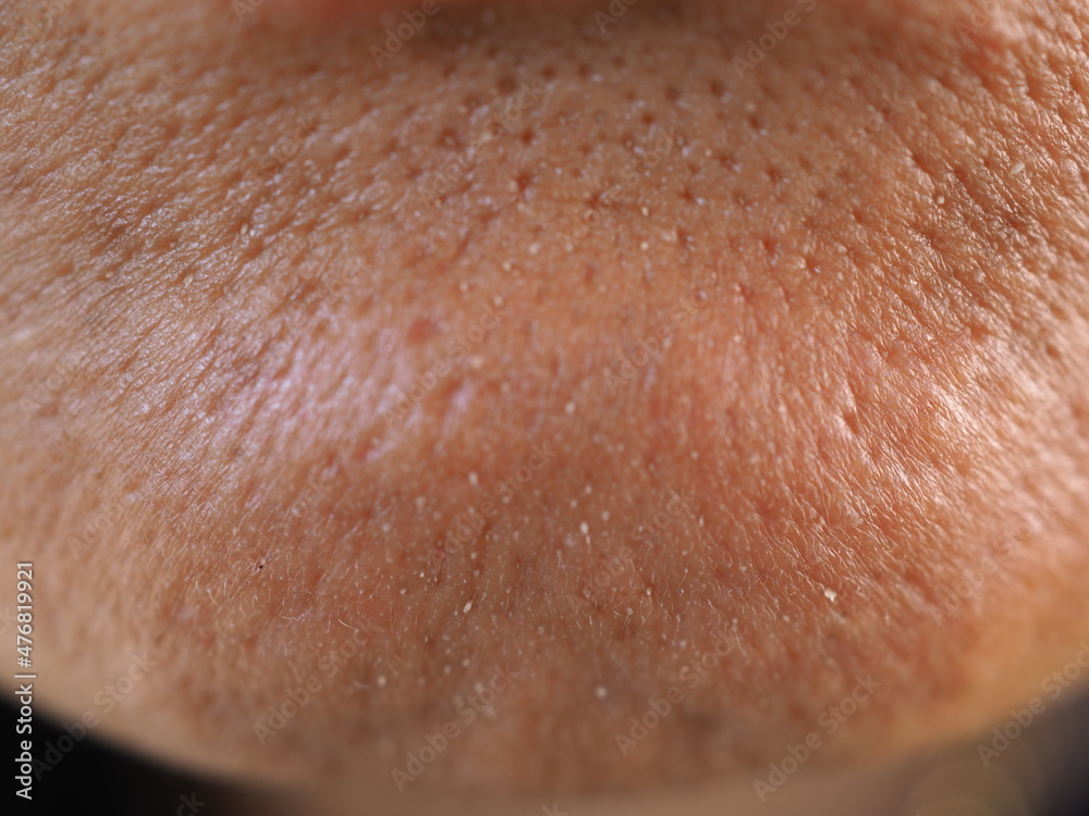 Fototapeta premium Asian woman has skin problem, large pores, whitehead and blackhead pimple. closeup photo, blurred.